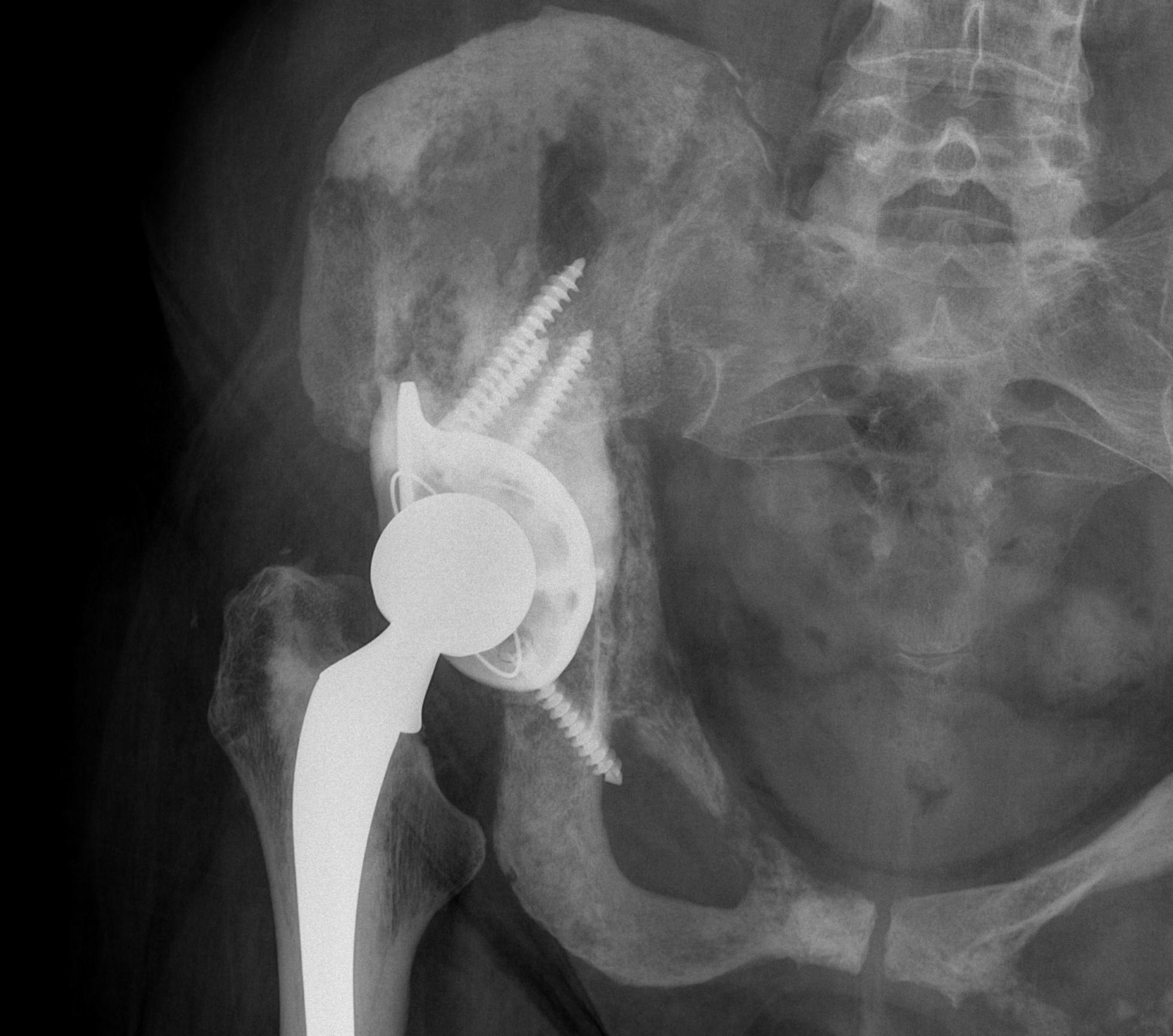 Acetabular Metastasis Antiprotrusio Cage